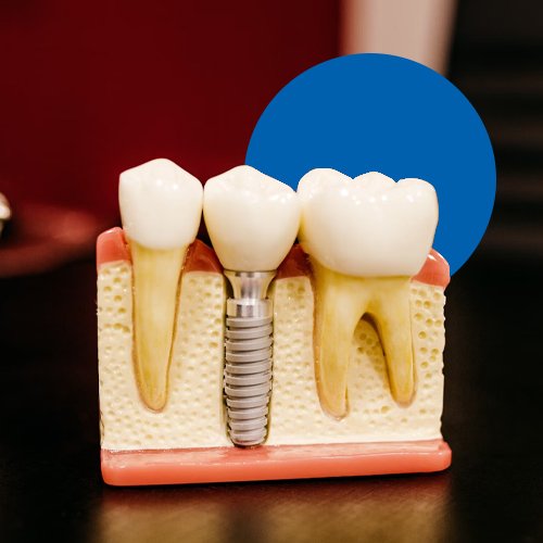 Dental Implants in Bangalore - ADP