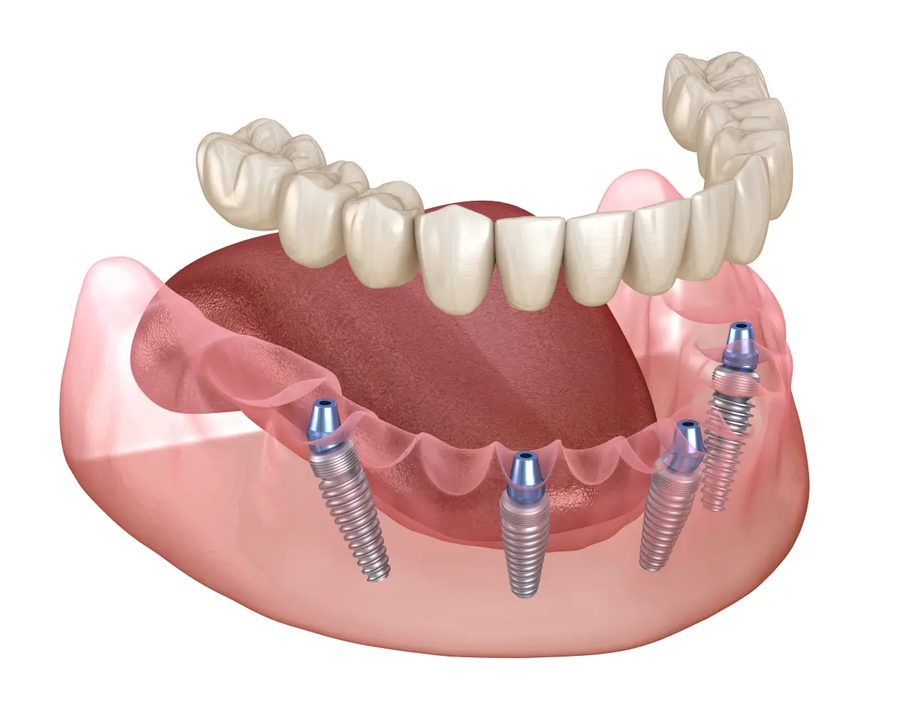 What are All on 4 Dental Implants? Treatment Procedure, Costs and More