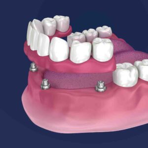 All on 4 dental implants - American Dental Practices