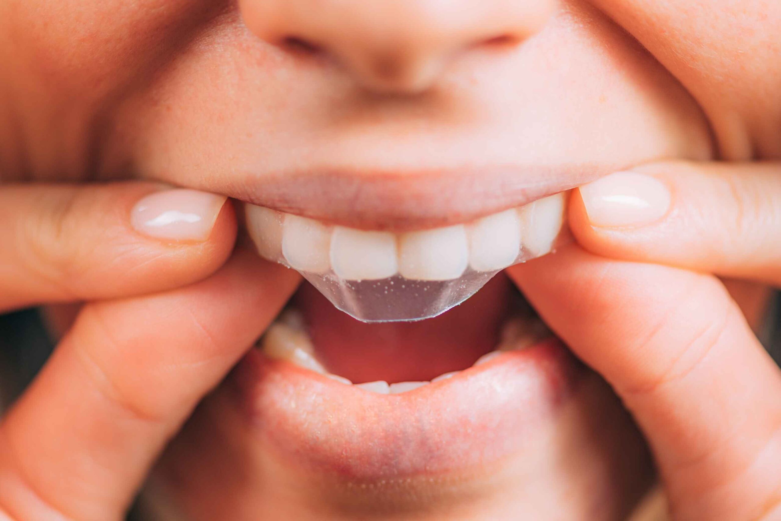 Teeth Whitening Strips: Do They Actually Work?