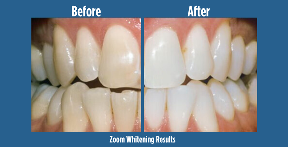 Zoom Teeth Whitening Before and After Results - American Dental Practices