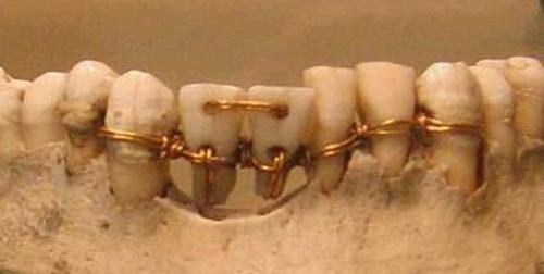 egyptians using braces older times - Teeth Gap fillings older methods