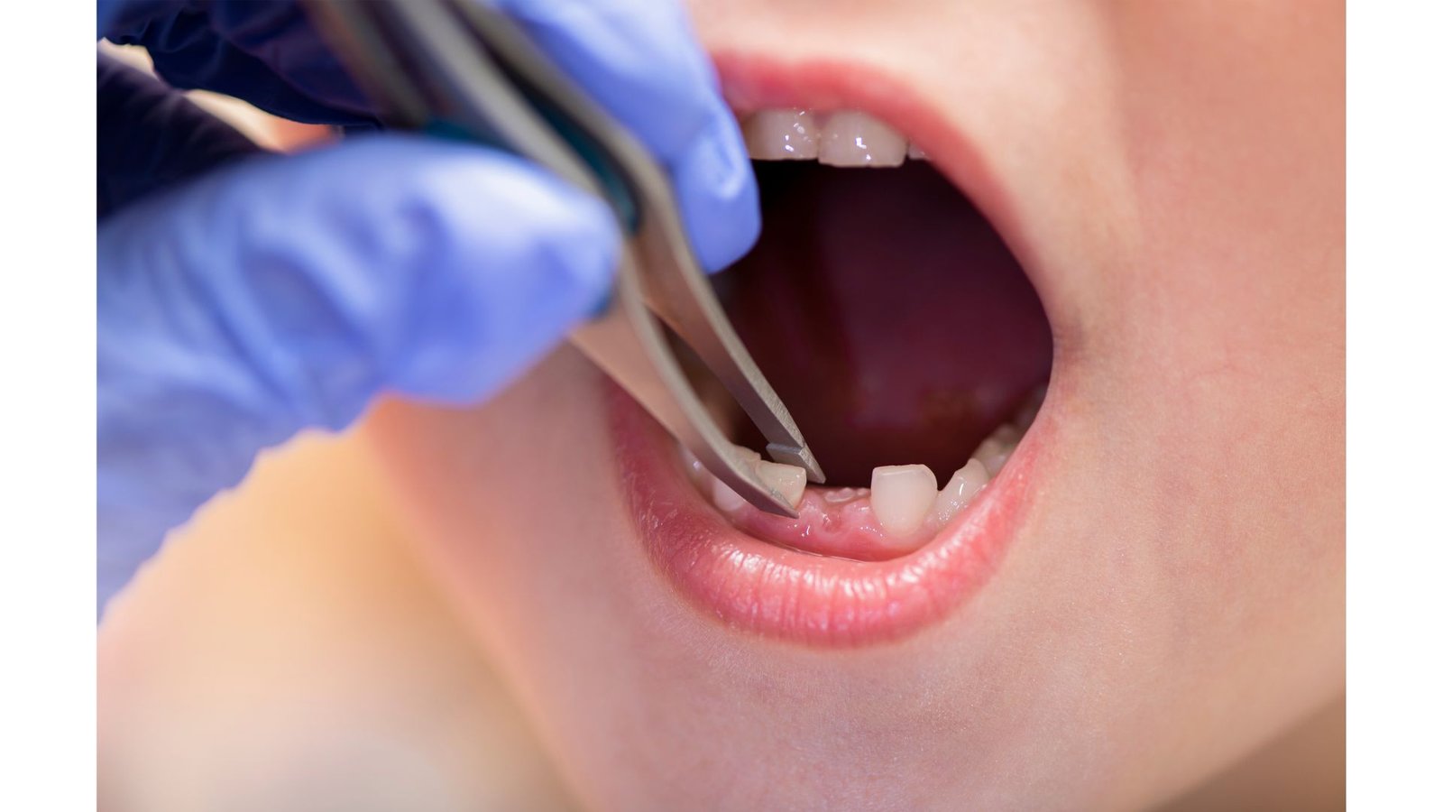 Crowns in Pediatric Dentistry: All You Need to Know