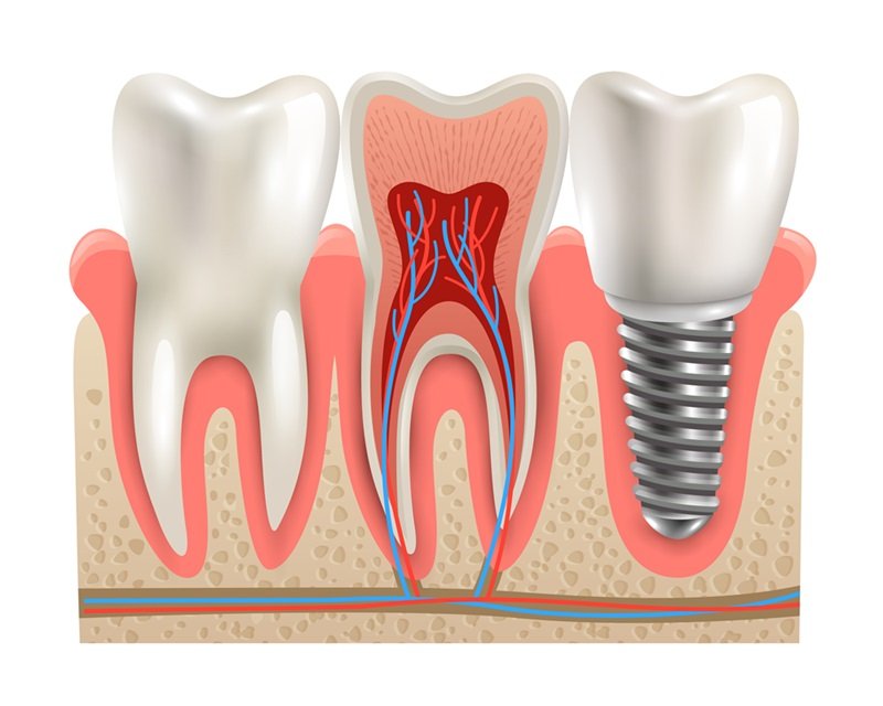 Dental Implants vs Dentures American Dental Practices Mumbai and Bangalore