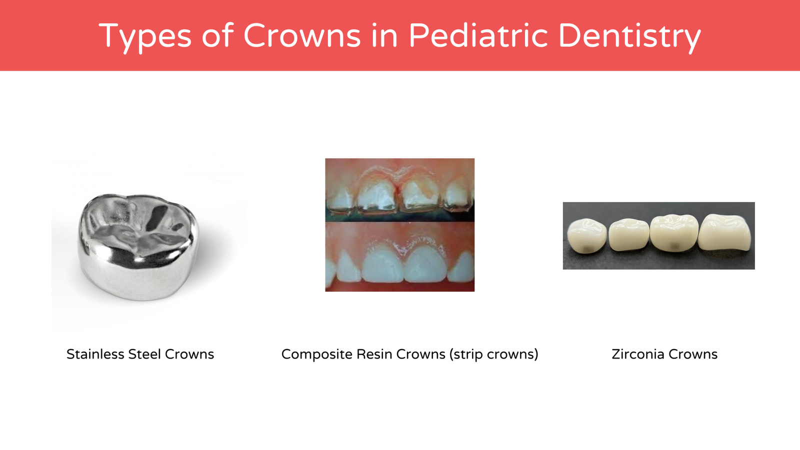 Types of Crowns in Pediatric Dentistry - American Dental Practices