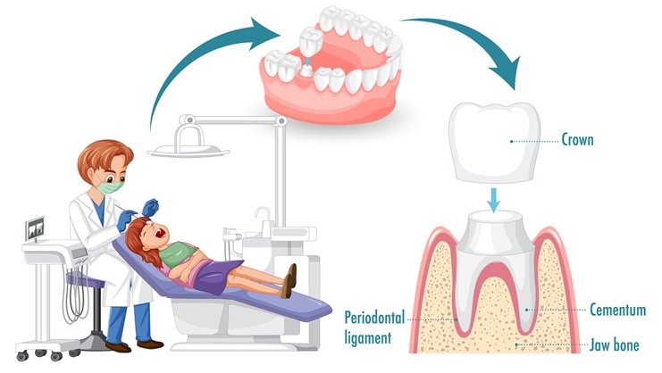 Dental Crowns and Bridges Crowns and bridges treatment in Mumbai Crowns and Bridges treatment in Bangalore American Dental Practices ADP 