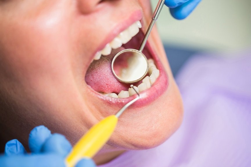 How To Remove Cavity From Teeth: Dental Procedures