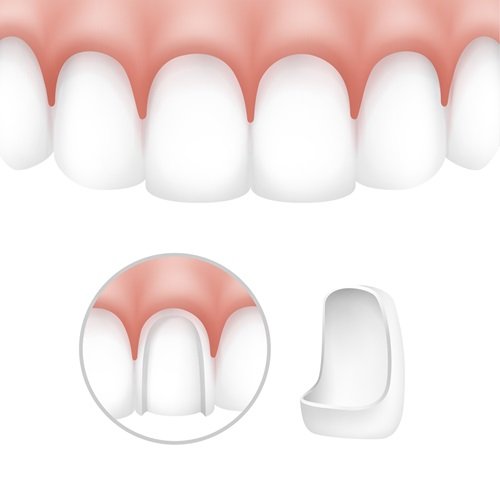 Porcelain vs. Composite Veneers: Which is the Right choice?