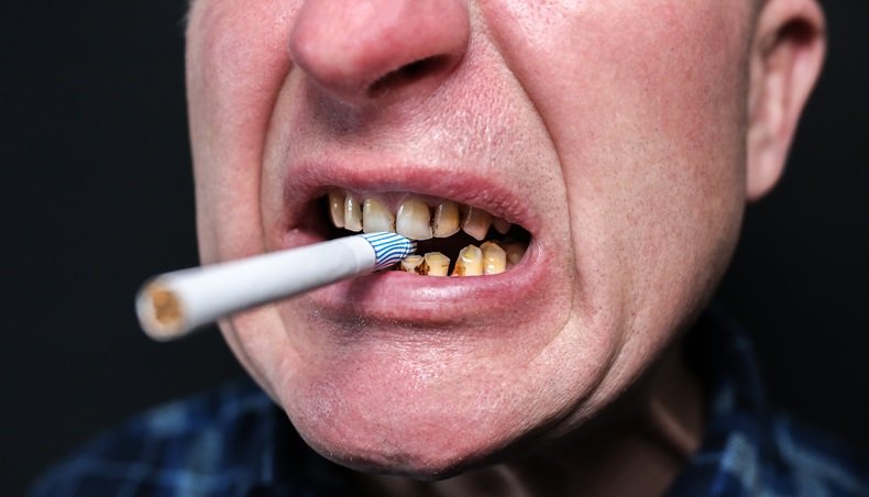 Teeth of Smokers: Side Effects of Smoking on Oral Health