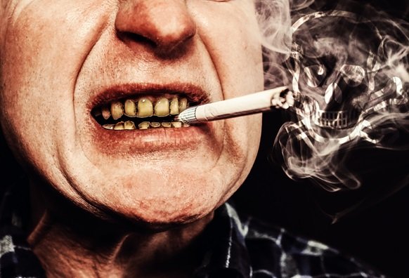 Teeth of Smokers Side Effects of Smoking on Oral Health - American Dental Practices