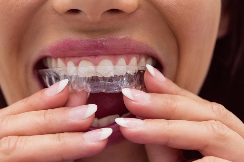 Invisible Braces for Teeth Gap: 7 Amazing Benefits