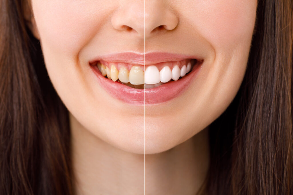 Looking for a Brighter Smile? Discover the Power of Teeth Whitening in Bangalore!