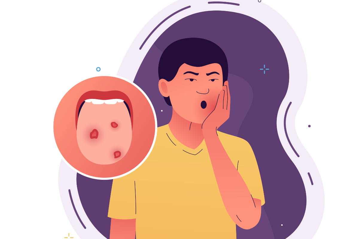 Everything You Need to Know About Mouth Ulcers and How to Treat Them