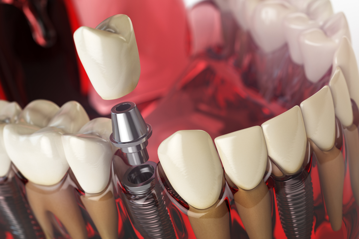 Basal Implants vs Conventional Dental Implants
