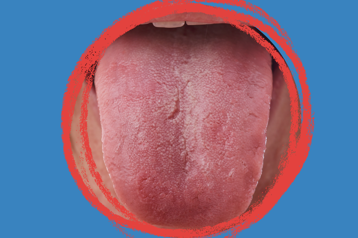 Why Does My Tongue Burn But Looks Normal? Understanding BMS Syndrome