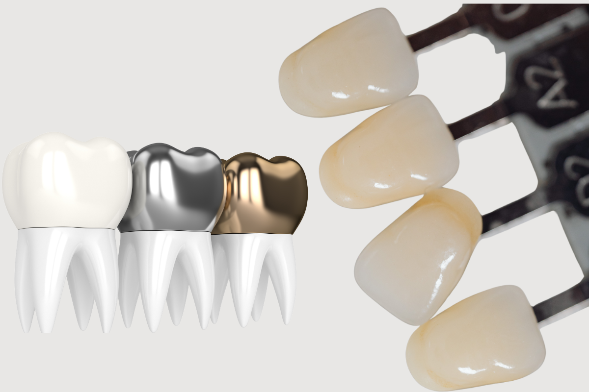 Which Looks More Natural: Veneers or Crowns?