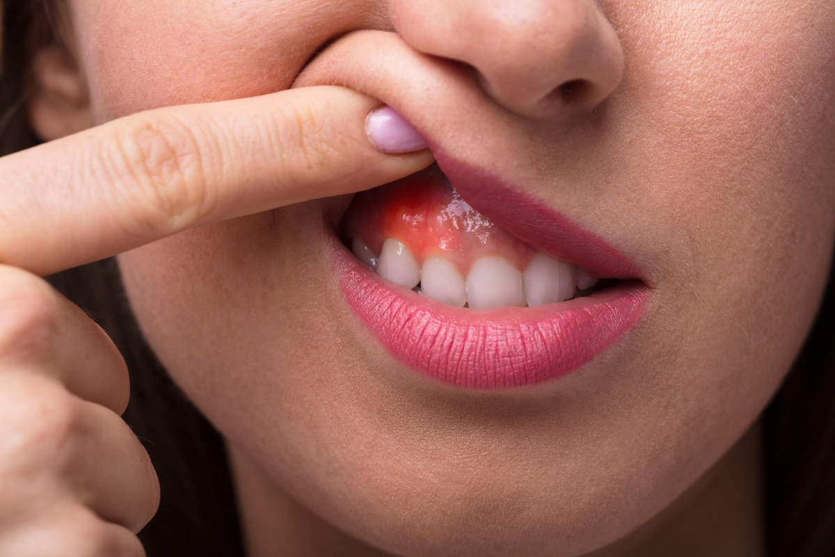Can a Gum Abscess Heal on Its Own?