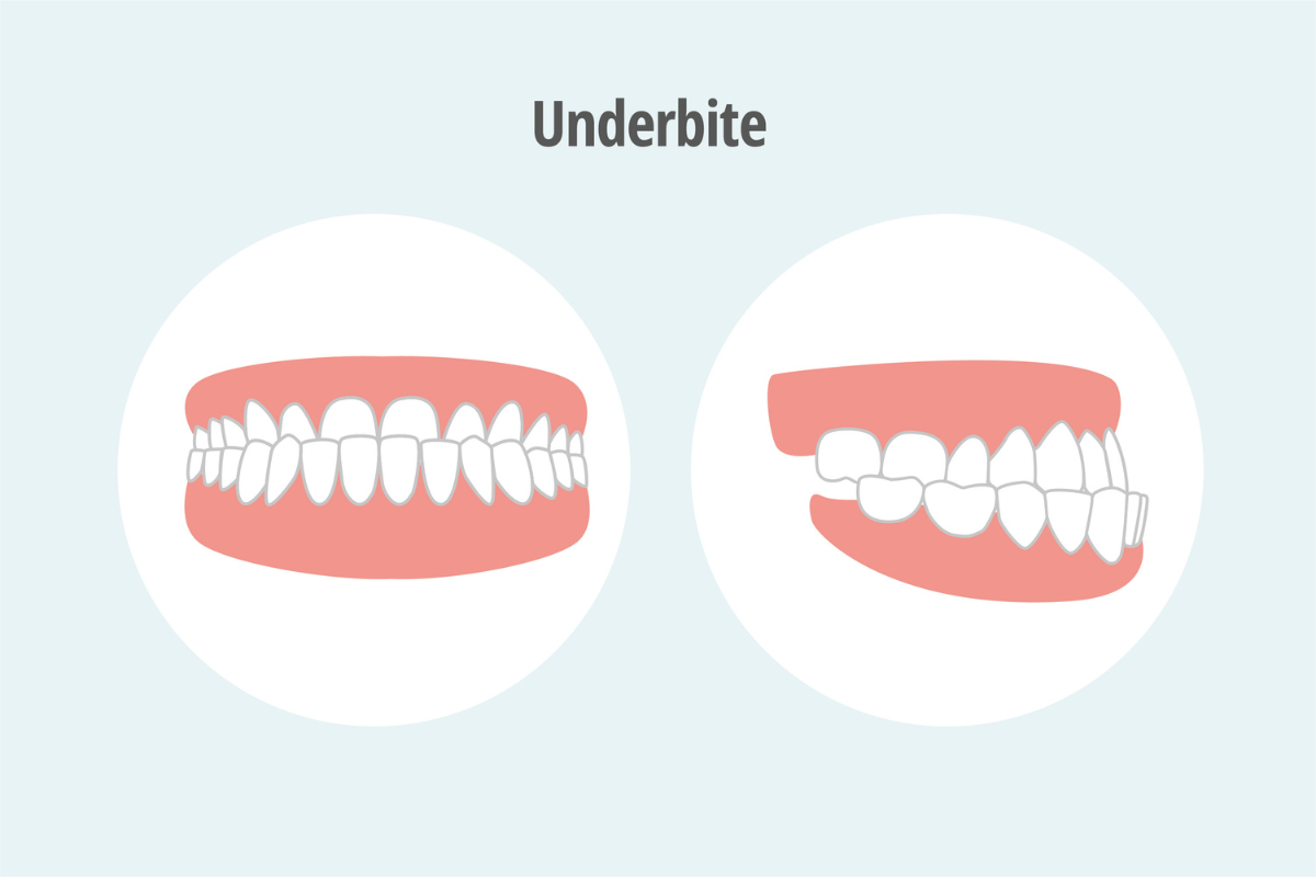 Cost of Underbite Treatment in India